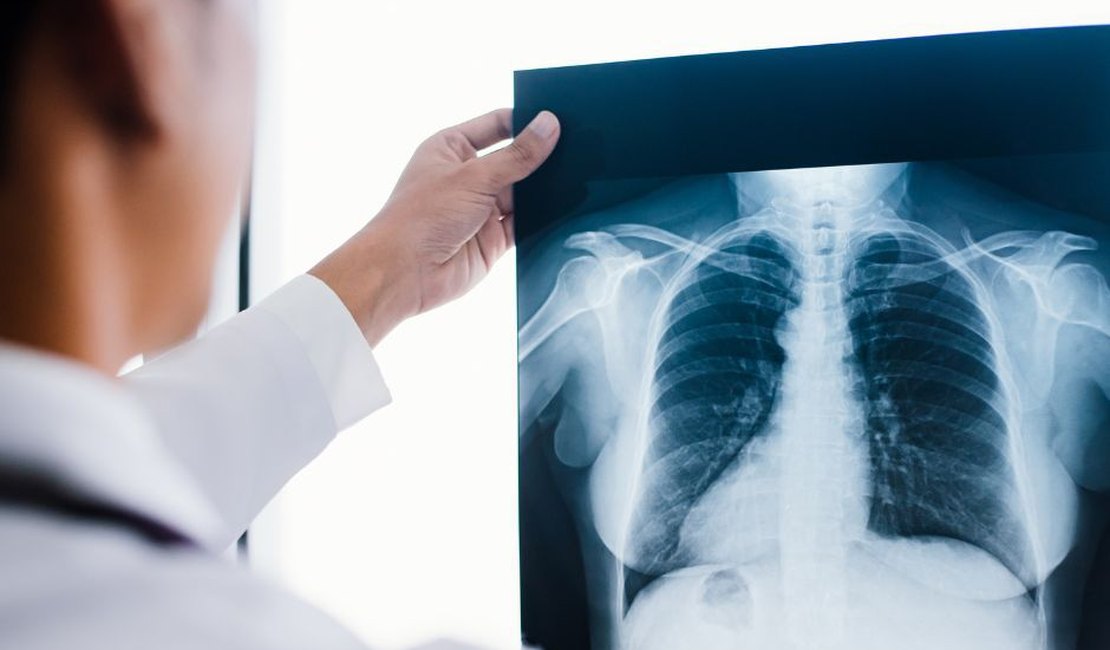 Saiba mais sobre a Fibrose Cística: condição genética que afeta pulmões e sistema digestivo