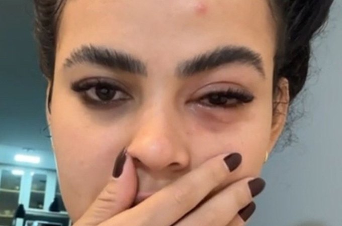 Mulher tem infecção no olho causada por mosca de banheiro