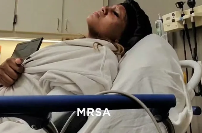 Atleta contrai superbactéria que corrói a carne após entrar em piscina de hotel