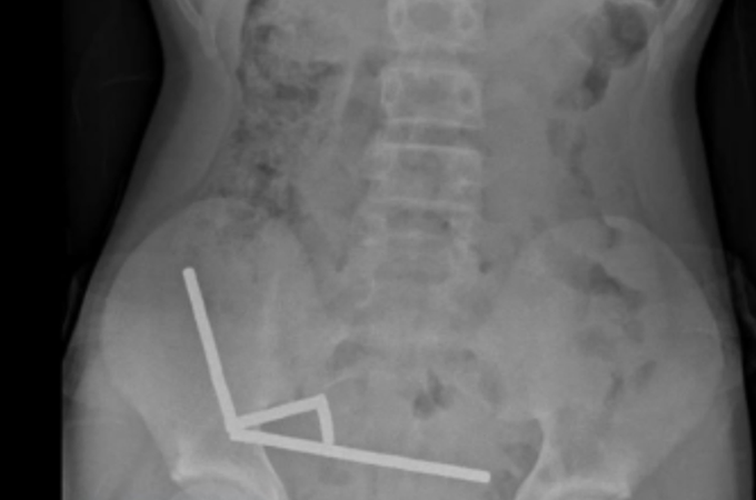 Menino de 13 anos perde parte do intestino após engolir mais de 80 ímãs