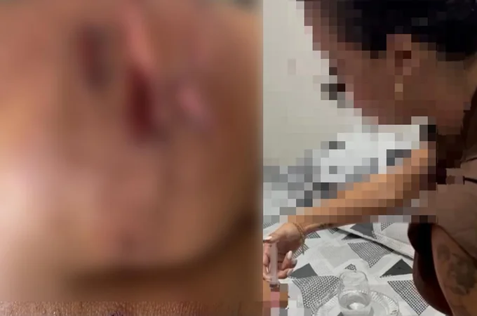 Dentista que usou silicone industrial e provocou lesão em pacientes é presa pela Polícia Civil, em Arapiraca