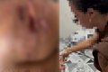 Dentista que usou silicone industrial e provocou lesão em pacientes é presa pela Polícia Civil, em Arapiraca
