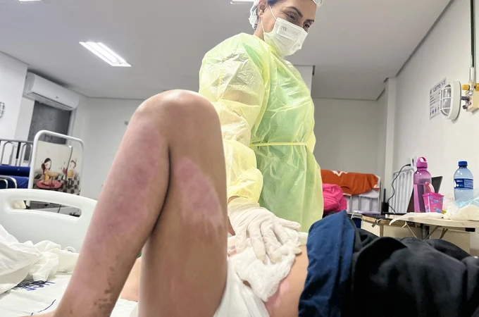 HGE alerta para os riscos causados por queimaduras e recomenda atenção também dentro de casa