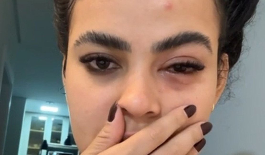 Mulher tem infecção no olho causada por mosca de banheiro