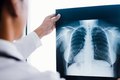 Saiba mais sobre a Fibrose Cística: condição genética que afeta pulmões e sistema digestivo