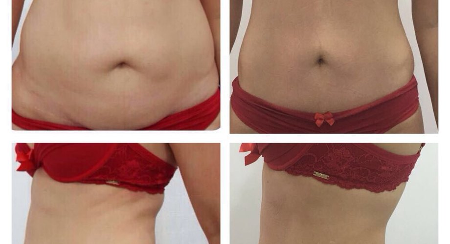 Esteticista fala sobre os benefícios da criolipólise