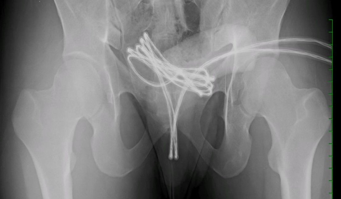 Estudante introduz cabo USB no pênis e precisa de cirurgia para retirada do objeto