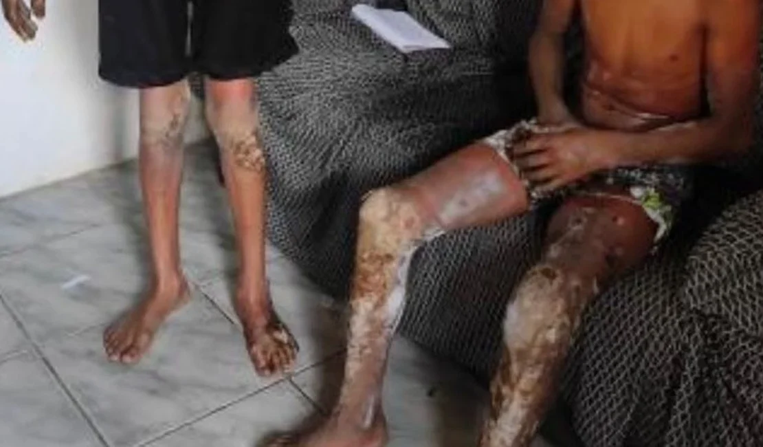 Jovem que teve 60% do corpo queimado em acidente com fogos de artifício é transferido para Maceió