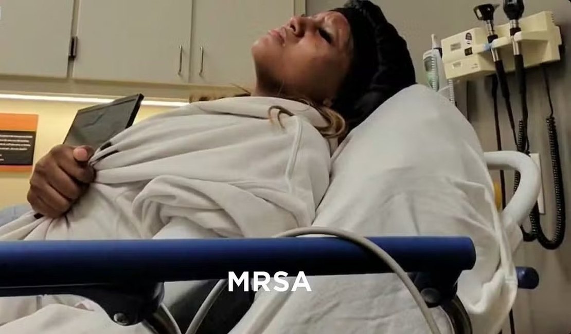 Atleta contrai superbactéria que corrói a carne após entrar em piscina de hotel