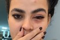 Mulher tem infecção no olho causada por mosca de banheiro