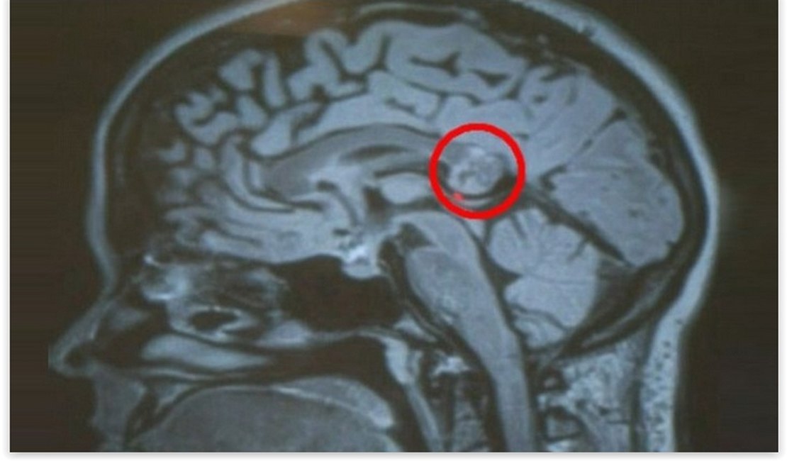 Mulher achou que tinha tumor e descobriu 'irmã gêmea' dentro do cérebro
