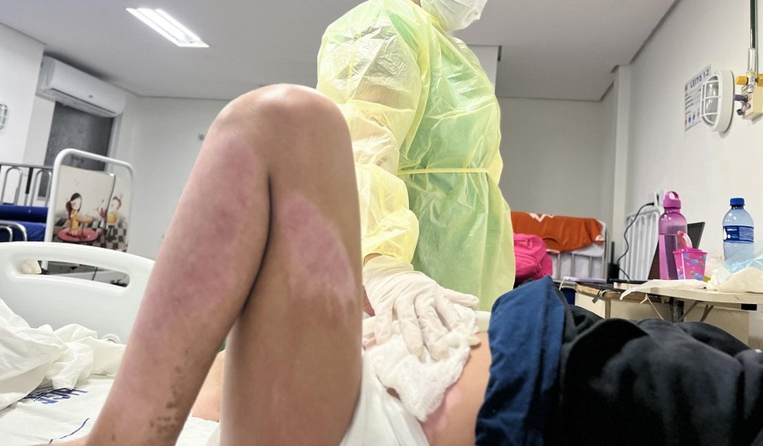 HGE alerta para os riscos causados por queimaduras e recomenda atenção também dentro de casa