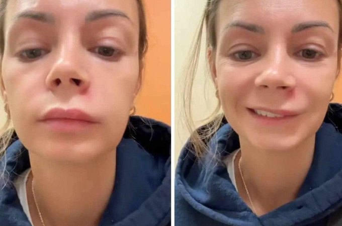 Influenciadora espreme espinha no ‘triângulo da morte’ e vai parar no hospital