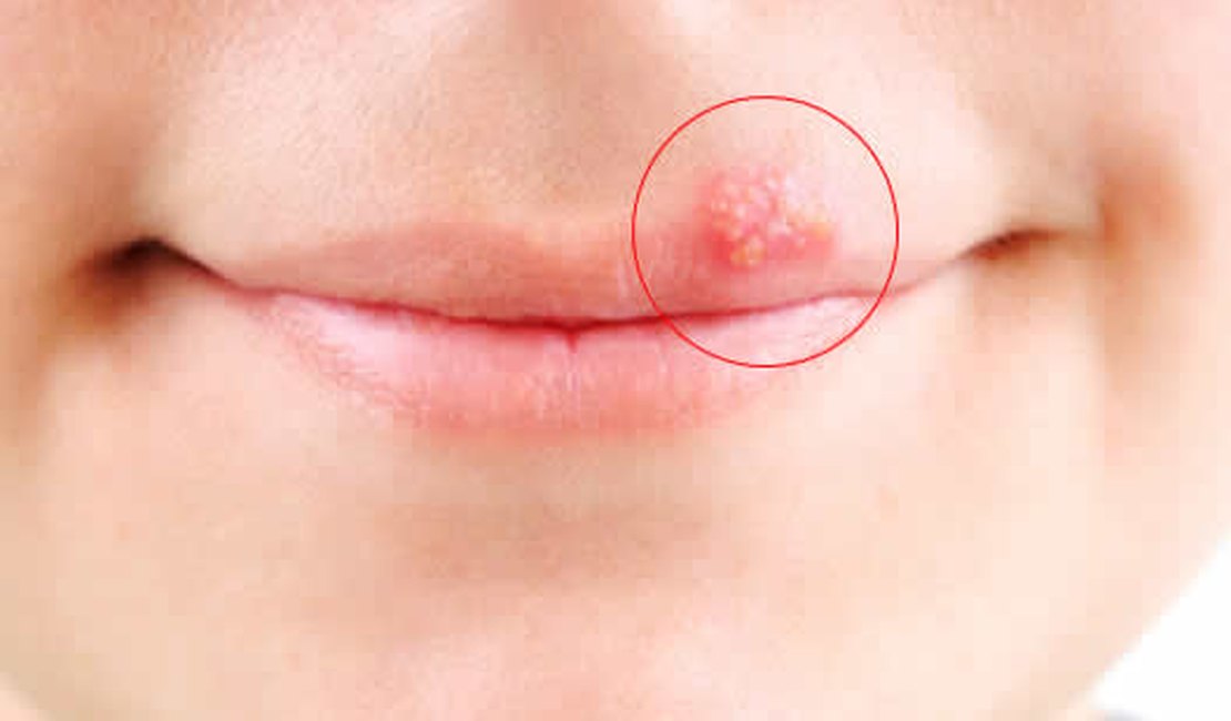 Herpes labial: o que é, porque surgem e como tratar?