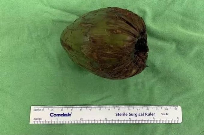 Homem é socorrido para o hospital após introduzir um coco no ânus