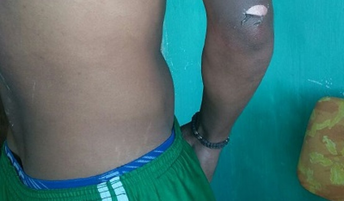 Jovem lança ‘desafio’ e ateia fogo ao próprio corpo no interior de AL
