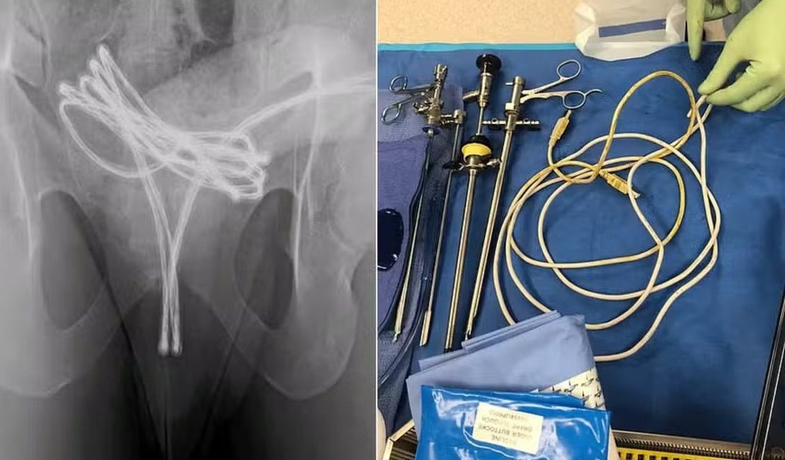 Homem de 21 anos é hospitalizado com cabo USB na uretra