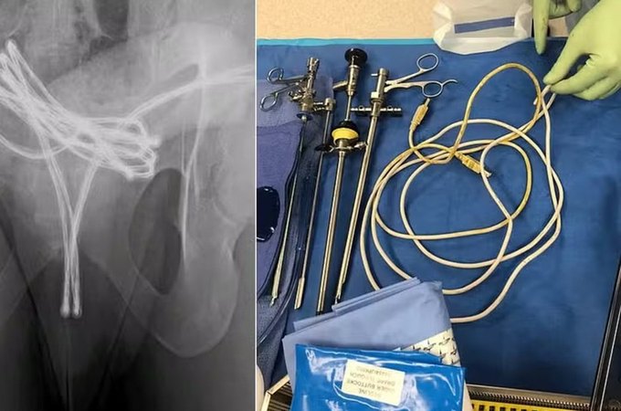 Homem de 21 anos é hospitalizado com cabo USB na uretra