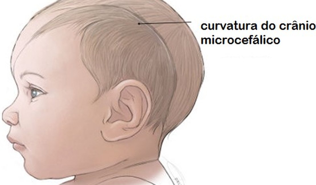 Casos suspeitos de microcefalia causados pelo vírus Zika somam 2.975