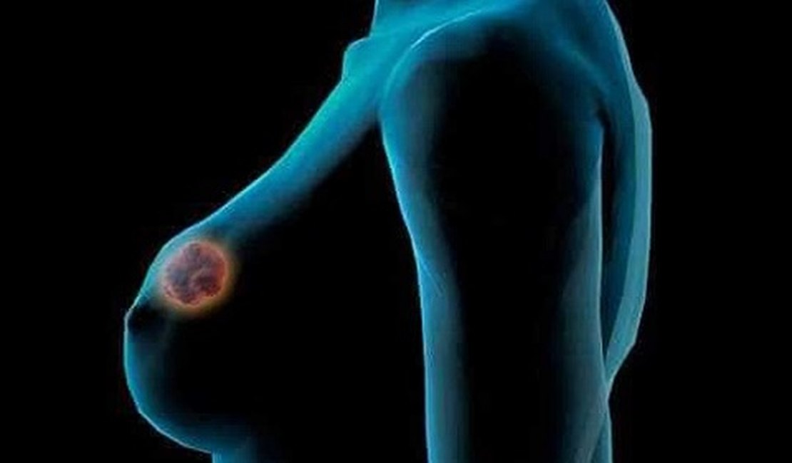 Saiba quais os riscos da quimioterapia tardia no tratamento do câncer de mama