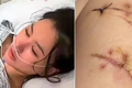 Mulher golpeada com faca 22 vezes é salva por próteses de silicone
