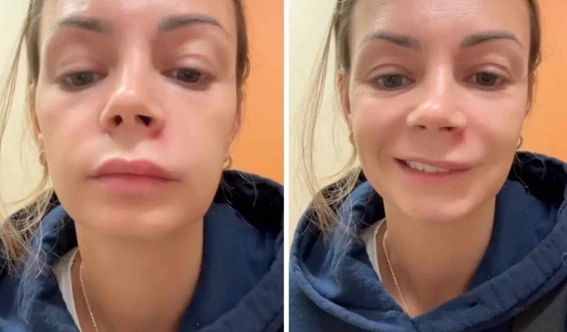 Influenciadora espreme espinha no ‘triângulo da morte’ e vai parar no hospital