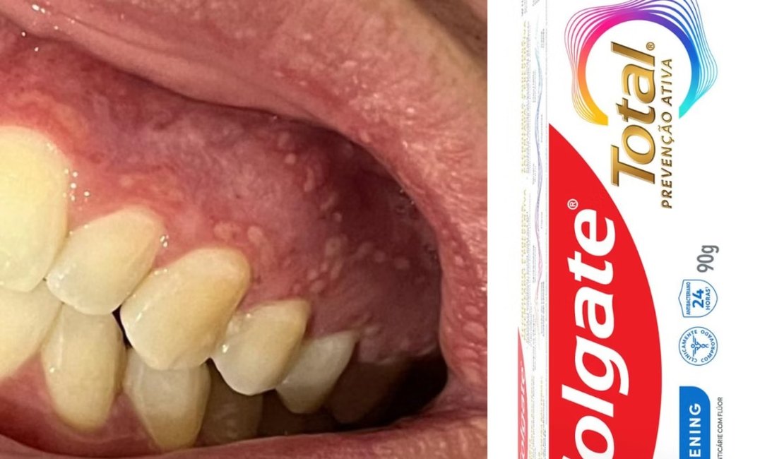 Estabelecimentos comerciais de Arapiraca devem retirar creme dental das prateleiras imediatamente; saiba mais