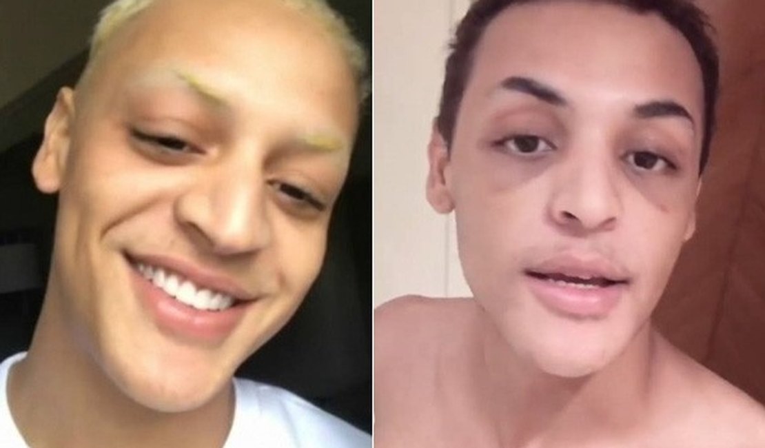 Pabllo Vittar mostra o resultado da cirurgia no nariz: 'Ficou bafo'