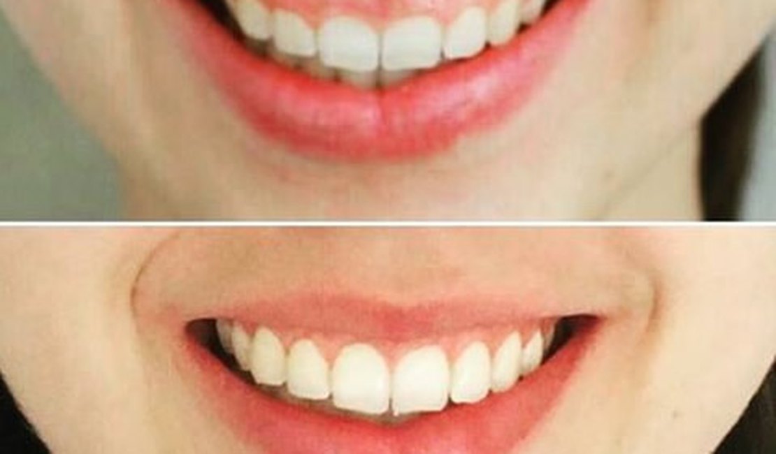 Saiba mais sobre cirurgia plástica periodontal