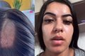 Mulher denuncia clínica após ter cabelo raspado em exame toxicológico para CNH