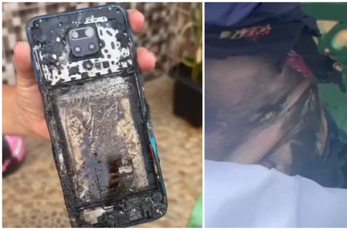 Técnica de enfermagem sofre queimaduras graves após celular pegar fogo, enquanto ela andava de moto