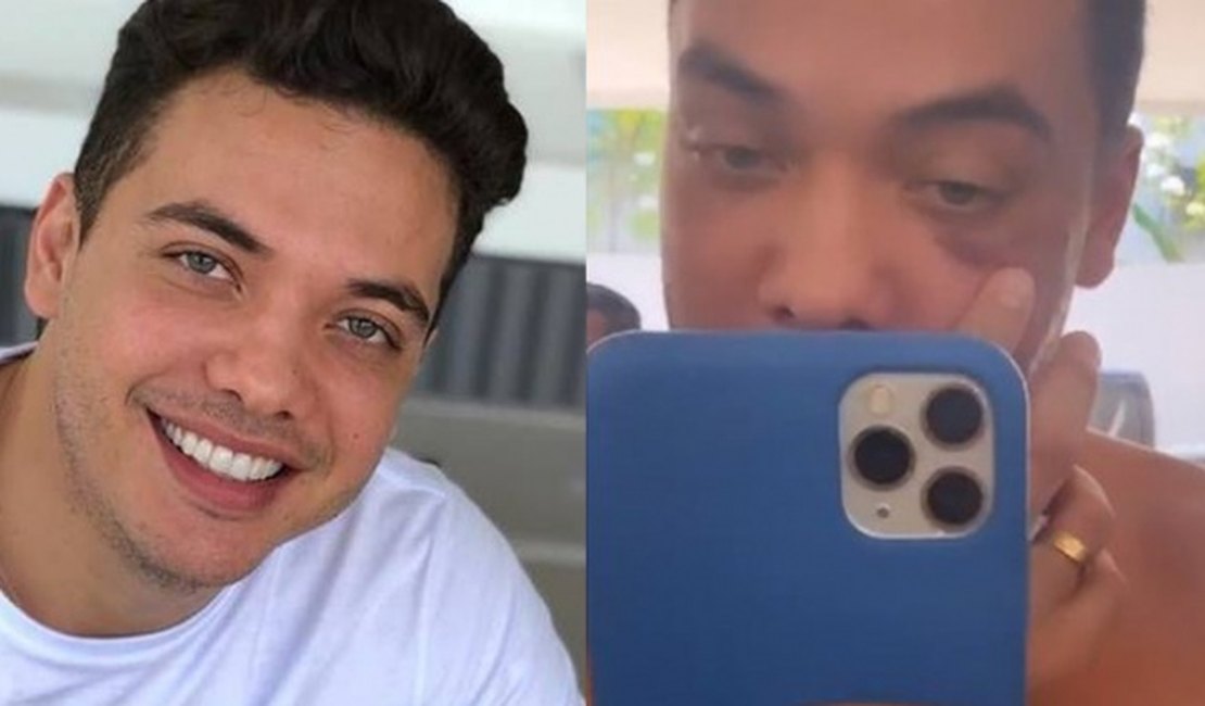 Wesley Safadão chama a atenção ao surgir com o olho roxo e revela o motivo