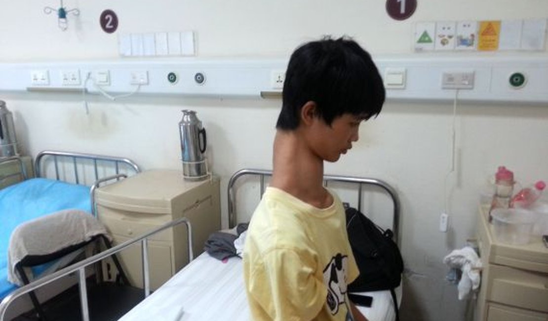 Adolescente chinês fará cirurgia para diminuir o tamanho do pescoço