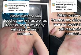 Jovem alérgica a água conta que sente dores intensas após contato com o líquido; entenda