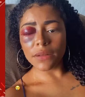 Mulher grava vídeo com olho roxo e denuncia namorado por agressão