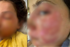 Menina de 10 anos sofre queimaduras graves no rosto após reproduzir desafio viral de rede social