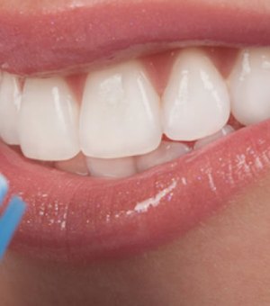 Qual é o melhor tipo de clareamento dental: procedimentos e técnicas