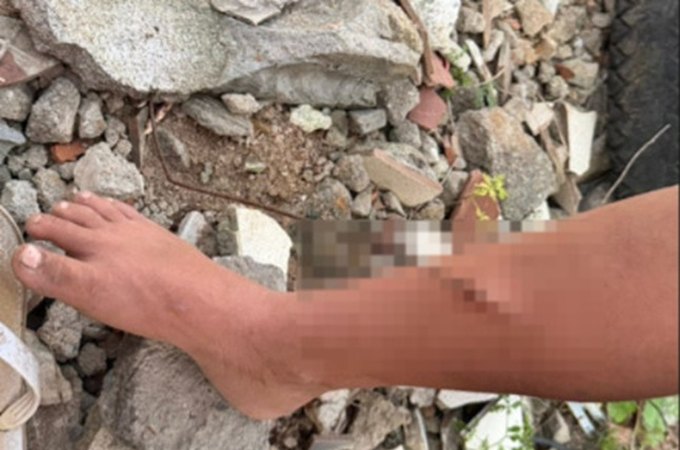 Criança tem perna perfurada por vergalhão enquanto buscava madeira para fogueira, em Arapiraca