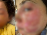 Menina de 10 anos sofre queimaduras graves no rosto após reproduzir desafio viral de rede social