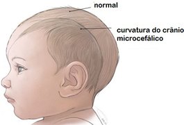 Casos suspeitos de microcefalia causados pelo vírus Zika somam 2.975