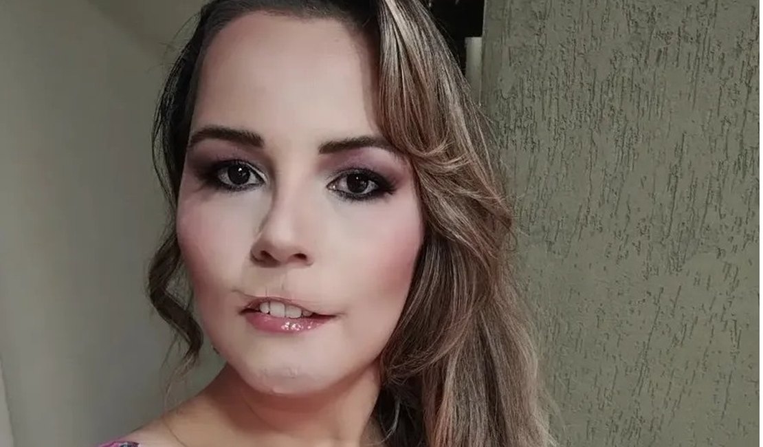 “Foi em troca de divulgação', diz mulher que perdeu lábio superior após realizar harmonização facial com PMMA