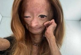 Morre aos 15 anos Adalia Rose, youtuber que sofria de doença semelhante à de Benjamin Button