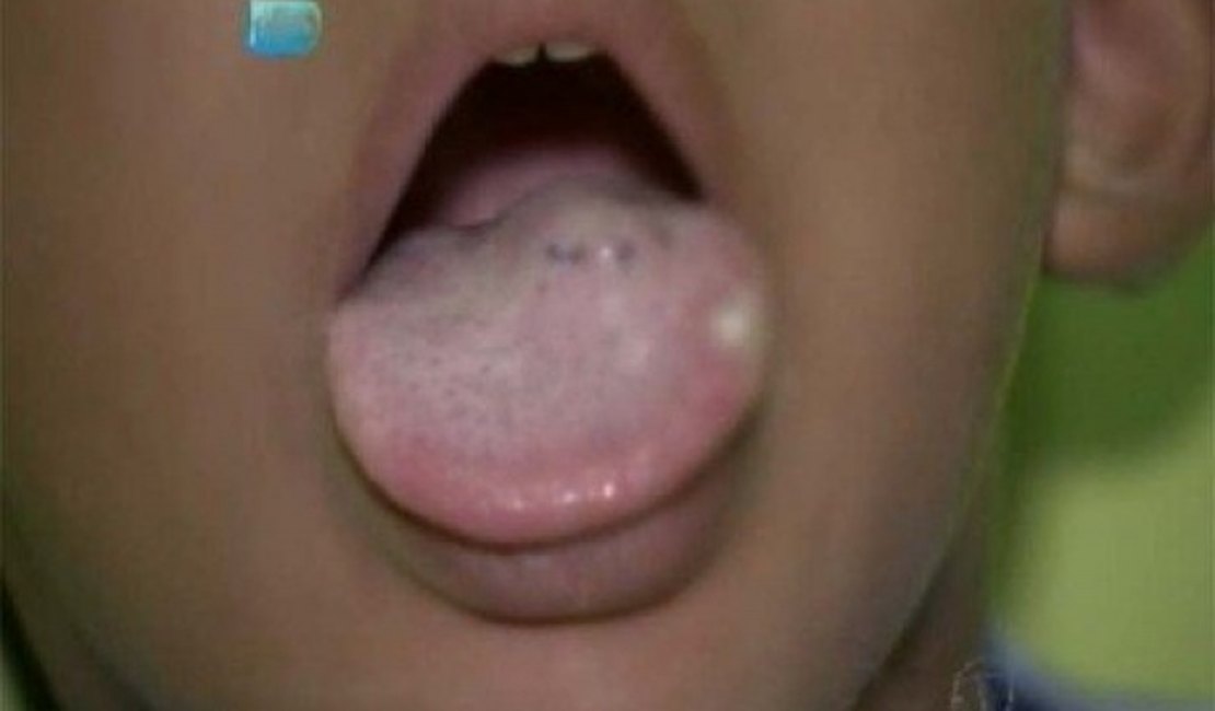 Criança de 4 anos tem língua cortada com faca por professora na BA