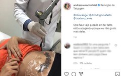 Andressa Urach em sessão de remoção de tatuagens