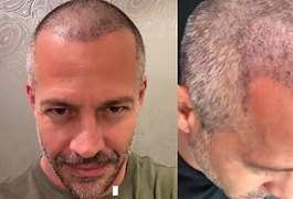 Aos 45 anos, Malvino Salvador exibe resultado na web de transplante capilar