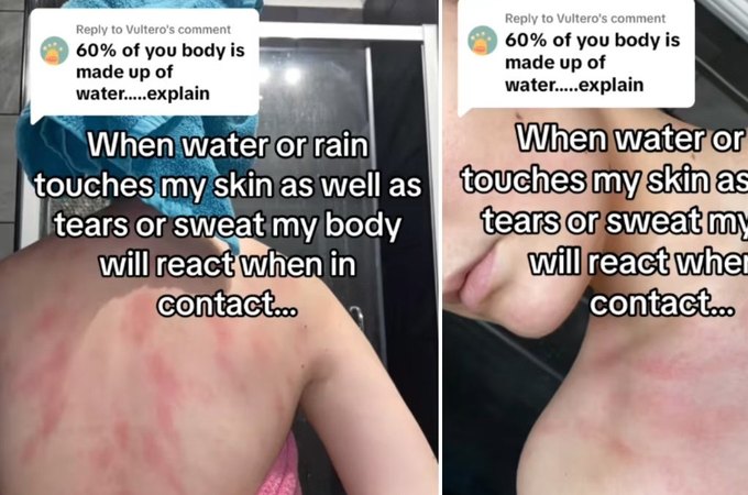 Jovem alérgica a água conta que sente dores intensas após contato com o líquido; entenda