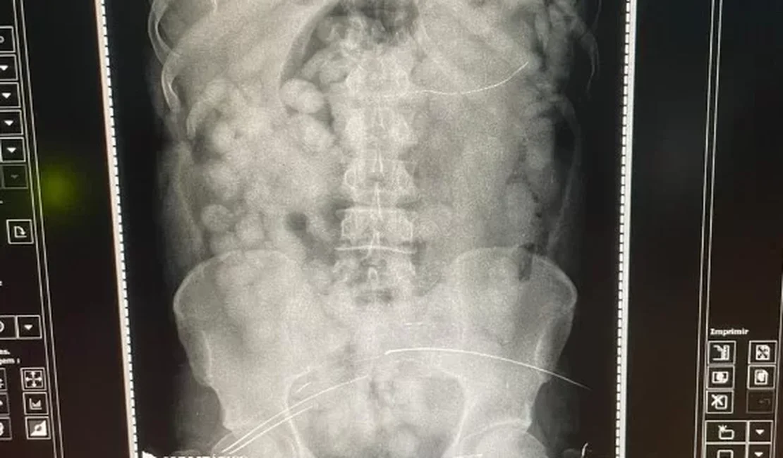 PF prende homem com estômago lotado de cocaína em aeroporto