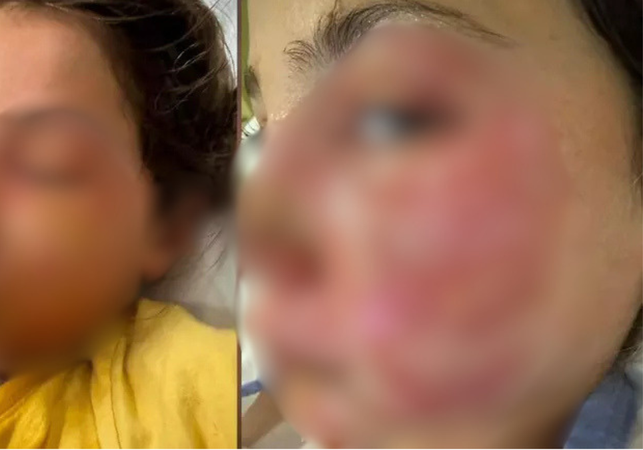 Menina de 10 anos sofre queimaduras graves no rosto após reproduzir desafio viral de rede social