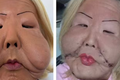 Veja o antes e depois do rosto da Juju do Pix após primeira cirurgia de reconstituição facial