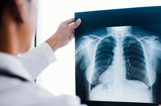 Saiba mais sobre a Fibrose Cística: condição genética que afeta pulmões e sistema digestivo